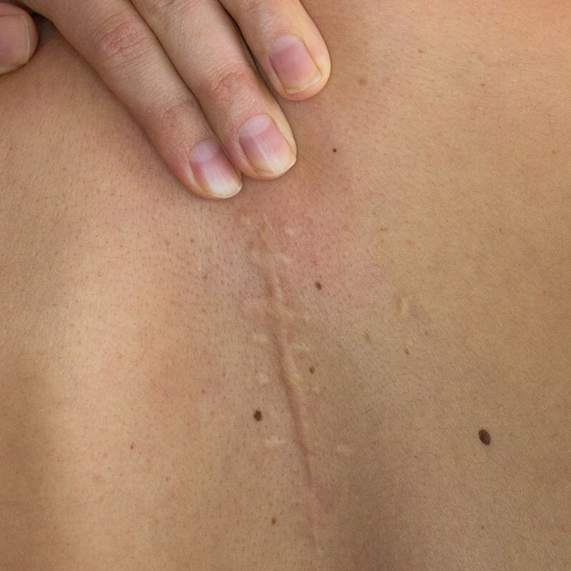 hypertrophic-scar-close-up hypertrophic-scar-close-up